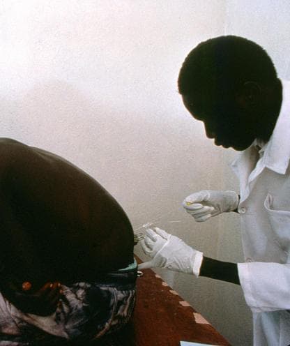 A clinical photograph depicting a healthcare professional performing a lumbar puncture (spinal tap) on a patient in a clinical setting. The patient is positioned in a lateral decubitus posture, lying on their side with the spine flexed and knees drawn toward the chest to increase the interspinous space. The healthcare worker, wearing a white lab coat and sterile gloves, is shown inserting a spinal needle into the lumbar region, specifically targeting the subarachnoid space to collect cerebrospinal fluid (CSF). The visual captures the precise manual technique required for this invasive procedure. Contextually, this diagnostic maneuver is illustrated here as a critical step in staging African Sleeping Sickness (Human African Trypanosomiasis) to detect central nervous system involvement. This image serves as a teaching tool for neuro-diagnostic procedures and clinical manifestations of tropical diseases in resource-limited environments.