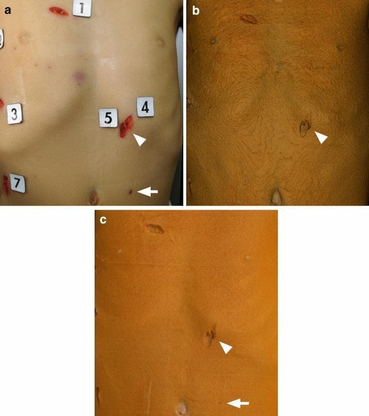 This forensic clinical comparison figure displays multiple stab wounds on a human torso using three imaging modalities: (a) a clinical photograph, (b) 3D computed tomography (CT) with volume rendering (VR), and (c) 3D CT with global illumination rendering (GIR). Panel (a) shows numerous sharp-force injuries with visible hemorrhage and numbered forensic markers. The arrowhead points to a prominent laceration. Panel (b) illustrates conventional VR, characterized by prominent contour-like striping artifacts on the skin surface and lower definition of wound margins. Panel (c) demonstrates GIR, which utilizes advanced lighting models to provide a smoother, more photorealistic skin surface. Comparison highlights the diagnostic superiority of GIR in forensic pathology; it successfully visualizes a small, shallow stab wound (arrow) and resolves adjacent injuries that appear coalesced or are undetectable in the VR image. The figure serves as an educational tool for comparing post-mortem radiological reconstruction techniques in trauma and forensic medicine.