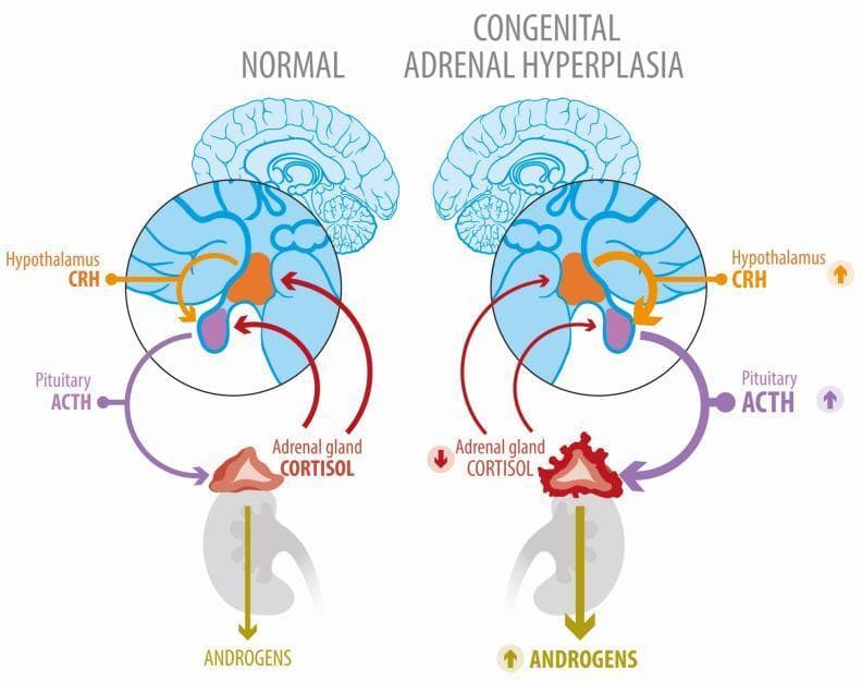 A comparative medical illustration of the Hypothalamic-Pituitary-Adrenal (HPA) axis under normal conditions and in Congenital Adrenal Hyperplasia (CAH). The 'Normal' panel displays a balanced feedback loop: the hypothalamus releases CRH to stimulate pituitary ACTH production, which in turn stimulates the adrenal gland to produce cortisol. Cortisol provides negative feedback to both the hypothalamus and pituitary. In the 'Congenital Adrenal Hyperplasia' panel, a block in the cortisol synthesis pathway (indicated by a downward red arrow) leads to reduced negative feedback. Consequently, the diagram shows compensatory increases in hypothalamic CRH and pituitary ACTH (upward purple and orange arrows). Visually, the adrenal gland in CAH is depicted as enlarged, irregular, and hyperplastic compared to the normal gland. This overstimulation by ACTH causes a metabolic shunt, resulting in significantly increased androgen production, represented by a thick, downward-pointing yellow arrow with an upward indicator. The diagram effectively illustrates the pathophysiology of 21-hydroxylase deficiency and the resulting secondary hyperandrogenism.