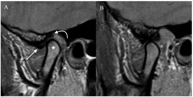 Diagnostic Image: This side-by-side sagittal proton density-weighted MRI illustrates the normal anatomy and functional dynamics of the human temporomandibular joint (TMJ). Image A shows the joint in the closed-mouth position. The mandibular condyle (marked with a star) is correctly seated within the mandibular fossa. The articular disc exhibits a classic hypointense, biconcave 'bow-tie' appearance, situated between the condyle and the temporal bone. Annotations identify the anterior band (straight arrow) and the posterior band (curved arrow). Image B demonstrates the joint in the open-mouth position, highlighting normal physiological movement. There is clear anterior translation and rotation of the mandibular condyle, which has moved forward and inferiorly toward the articular eminence. The articular disc maintains its relationship with the condyle during this transition. This comparison serves as a clinical reference for assessing disc displacement and jaw range of motion, essential in diagnosing internal derangement of the TMJ.