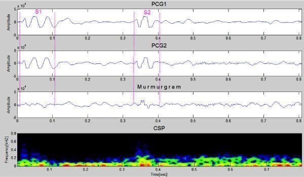 Phonocardiogram (PCG) analysis from a 23-year-old female patient with a benign innocent heart murmur. The image presents four stacked panels representing time-series data over an 0.8-second cardiac cycle. Panels 1 and 2 (PCG1 and PCG2) display the raw acoustic cardiac signal, highlighting the first heart sound (S1) at approximately 0.1 seconds and the second heart sound (S2) at approximately 0.4 seconds. Panel 3, the 'Murmurgram,' represents the difference signal between adjacent PCG cycles, appearing relatively flat with minor amplitude fluctuations, which is characteristic of non-pathological murmurs. Panel 4 is a Color Spectrogram (CSP) showing the frequency distribution (kHz) over time. The CSP indicates that the heart sounds and associated innocent murmur consist primarily of low-frequency components under 0.2 kHz (150-200 Hz), with minimal high-frequency extension. This diagnostic visualization is used in cardiology to differentiate between innocent physiological murmurs and pathological murmurs (e.g., VSD, ASD, or valvular stenosis) based on spectral density and temporal distribution between S1 and S2.