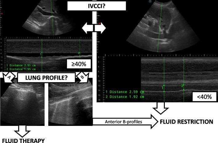 This diagnostic algorithm flowchart integrates Inferior Vena Cava Collapsibility Index (IVCCI) and Point-of-Care Lung Ultrasound (LUS) to guide preoperative fluid management. The top row illustrates IVCCI assessment using combined B-mode and M-mode ultrasonography. The left panel shows a highly collapsible IVC (distensibility/collapsibility ≥40%, e.g., 2.51 cm to 1.55 cm), suggesting fluid responsiveness. The right panel shows a plethoric IVC with low collapsibility (<40%, e.g., 2.59 cm to 1.92 cm). The bottom row displays lung profiles based on the BLUE protocol. Profile A (left) shows characteristic horizontal 'A-lines', indicating dry lungs and normal aeration, leading toward fluid therapy. Profile B (right) demonstrates vertical, laser-like 'B-lines' (comet-tail artifacts) arising from the pleural line, indicating interstitial syndrome or pulmonary edema. The algorithm concludes with decision nodes: patients with A-profiles and high IVCCI are directed toward 'FLUID THERAPY', while those with anterior B-profiles or low IVCCI are directed toward 'FLUID RESTRICTION' to prevent volume overload.