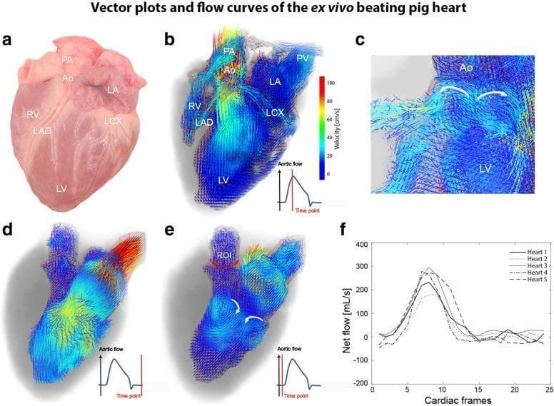 This composite educational graphic illustrates hemodynamic modeling in a beating ex vivo pig heart, a common model for human cardiac research. (a) A clinical photograph provides an anatomical reference, labeling the aorta (Ao), pulmonary artery (PA), left atrium (LA), left ventricle (LV), and coronary arteries (LAD, LCX). (b) A 4D flow MRI velocity vector plot during the systolic ejection phase shows blood accelerating (red-yellow vectors) from the LV into the aorta. (c) A magnified view of the aortic root demonstrates diastolic vortex formation and retrograde filling of the coronaries. (d, e) Comparison vector plots of a segmented LV depict flow dynamics at end-systole (d) versus end-diastole (e). The latter highlights complex intracardiac flow, including the formation of late diastolic vortices (white arrows) as the ventricle fills. A color-coded velocity scale (0–100 cm/s) assists in quantifying flow intensity. (f) A line graph displays net aortic flow (mL/s) across 25 cardiac frames for five separate experiments, demonstrating consistent peak systolic flow and minor diastolic regurgitation across subjects.