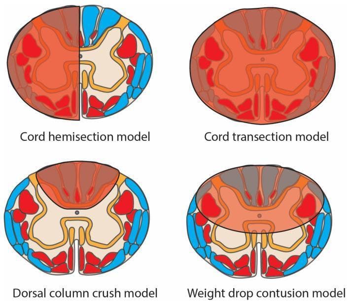 This medical schematic diagram illustrates four pre-clinical spinal cord injury (SCI) models in axial cross-section, highlighting damaged regions (translucent red overlay), motor tracts (opaque red), and sensory tracts (blue). 1. Cord Hemisection Model: Shows damage isolated to one lateral half of the spinal cord, characteristic of Brown-Séquard syndrome, affecting both motor and sensory tracts on the ipsilateral side. 2. Cord Transection Model: Depicts complete injury across the entire cord diameter, resulting in total disruption of all motor and sensory pathways. 3. Dorsal Column Crush Model: Features localized damage concentrated in the posterior (dorsal) funiculus, primarily affecting ascending sensory tracts. 4. Weight Drop Contusion Model: Displays a diffuse, central injury zone impacting the grey matter and surrounding white matter tracts, simulating clinical traumatic contusion. The diagram serves as an educational tool for comparing injury patterns across experimental models used in neurotrauma research and their resulting impact on anatomical tracts.