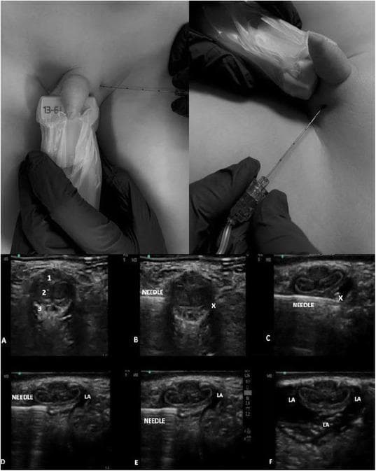 Educational composite image illustrating the ultrasound-guided dorsal penile nerve block (US-DPNB) technique. The upper panels show clinical photographs of the procedural setup, featuring a high-frequency linear ultrasound probe (13-6 MHz) in a sterile sleeve and the insertion of a block needle into the suprapubic/penile base region. The lower section consists of a six-panel ultrasound sequence (A-F) in transverse cross-section. Image A identifies the anatomy: corpus spongiosum (1), corpora cavernosa (2), and Buck’s fascia (3). Images B and C demonstrate the hyperechoic needle advancing toward the target (X) beneath Buck’s fascia. Images D through F show the real-time administration of local anesthetic (LA), visualized as an expanding anechoic/hypoechoic area surrounding the dorsal nerves and vascular structures. This material serves as a clinical guide for regional anesthesia in urological procedures, emphasizing needle trajectory and pharmacological spread relative to penile internal anatomy.