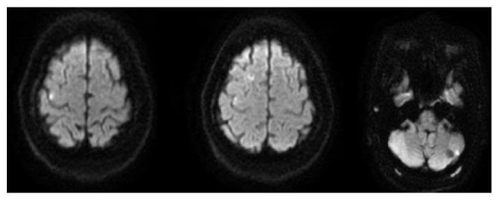 Diagnostic Image: Three axial MRI brain slices, specifically Diffusion-Weighted Imaging (DWI) sequences, demonstrating focal areas of diffusion restriction consistent with acute ischemic infarctions. The first slice (left) shows a superior axial view of the cerebral hemispheres with a small, hyperintense (bright) ovoid focus in the right frontal lobe. The second slice (middle) displays the mid-cerebral level with no significant focal lesions at this cross-section. The third slice (right) is an inferior view through the posterior fossa, highlighting a distinct focal area of increased signal intensity in the left cerebellar hemisphere. The bilateral distribution of these acute infarcts (involving both the anterior circulation and posterior circulation) is clinically significant for a suspected cardioembolic or aortic embolic source. This imaging is characteristic of acute cerebral ischemia and serves as an educational example of how diffusion restriction appears on MRI during the hyperacute to acute phase of stroke.