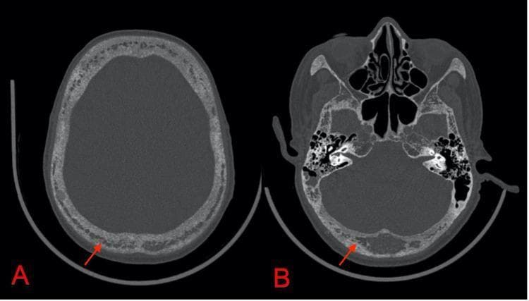 This diagnostic image consists of two axial non-contrast CT scans of the head in the bone window, highlighting the calvaria (A) and the skull base (B). The images demonstrate diffuse, spotty osteopenia throughout the cranial vault and base. There is a characteristic 'salt and pepper' morphology, signifying a loss of normal trabecular pattern and the presence of multiple tiny, interspersed radiolucent and sclerotic foci. Red arrows in both panels point to specific areas of bone remodeling and decreased density. These radiographic findings are classic manifestations of hyperparathyroidism, such as that seen in tertiary hyperparathyroidism secondary to chronic kidney disease (CKD), where excessive parathyroid hormone leads to significant bone resorption. The image serves as an educational reference for identifying 'salt and pepper skull' and understanding the skeletal complications of metabolic bone disease within the field of radiology and endocrinology.