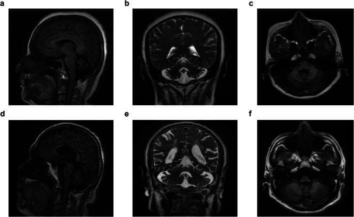 This diagnostic imaging panel presents a multi-planar MRI series of the brain for two separate individuals diagnosed with Spinocerebellar Ataxia Type 5 (SCA5). The top row (a–c) displays the proband, while the bottom row (d–f) displays a sporadic patient. The modalities include sagittal T1-weighted images (a, d), coronal T2-weighted images (b, e), and axial T1-weighted images (c, f). The primary clinical finding across both patients is moderate cerebellar atrophy. In the sagittal views, there is noticeable widening of the cerebellar fissures and a reduction in the volume of the cerebellar vermis. The coronal T2-weighted images highlight prominent cerebellar folia and enlarged CSF spaces surrounding the cerebellum, indicative of parenchymal loss. Despite the cerebellar changes, the supratentorial structures, including the cerebral cortex and ventricular system, appear largely preserved with normal ventricular size. This pattern is characteristic of pure cerebellar ataxia syndromes where atrophy is predominantly isolated to the infratentorial compartment, specifically the cerebellum and brainstem.