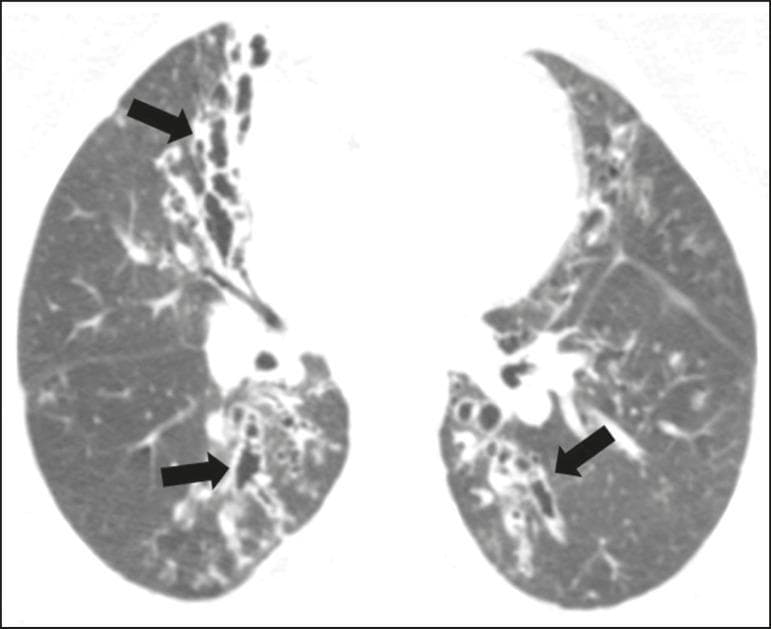 This diagnostic image is an axial computed tomography (CT) scan of the chest presented in a lung window setting. The image demonstrates hallmark radiological features of Allergic Bronchopulmonary Aspergillosis (ABPA) in a patient with a history of asthma. The primary finding is widespread, predominantly central varicose bronchiectasis involving segmental and subsegmental bronchi. The affected airways show irregular, 'beaded' bronchial dilation rather than uniform cylindrical expansion. Black arrows highlight significant bronchial parietal thickening, indicating chronic airway inflammation and wall remodeling. The distribution of the bronchiectasis is most prominent in the upper lobes and central regions, sparing the extreme lung periphery. Aside from these peribronchovascular changes, the surrounding lung parenchyma appears largely preserved without diffuse interstitial disease. This presentation is highly characteristic of the hypersensitivity response to Aspergillus species, leading to impaired mucociliary clearance and subsequent permanent airway damage.
