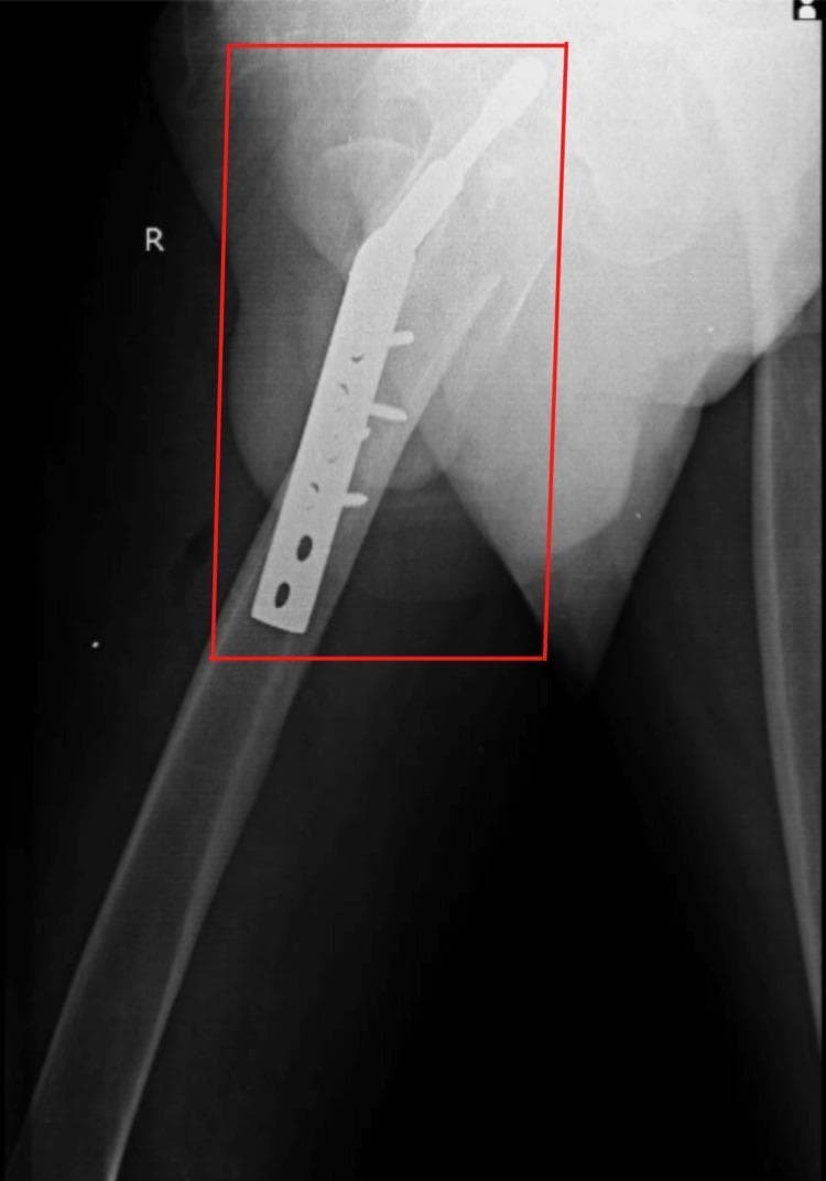 This lateral view X-ray radiography demonstrates the postoperative results of open reduction internal fixation (ORIF) for a right-sided proximal femur fracture. The image shows a dynamic hip screw (DHS) system in situ, consisting of a large-diameter lag screw traversing the femoral neck into the femoral head, coupled with a side plate secured to the femoral shaft using multiple cortical screws. The hardware is positioned to stabilize an intertrochanteric fracture with subtrochanteric extension. The lateral projection allows for assessment of the sagittal alignment of the femur and the central placement of the lag screw within the femoral head. There are visible radiolucent lines indicating the original fracture planes between the intertrochanteric fragments and the femoral shaft. This imaging is characteristic of orthopedic trauma management in adult patients following a low-energy fall, illustrating the mechanical stabilization of extracapsular hip fractures to facilitate early mobilization and rehabilitation.