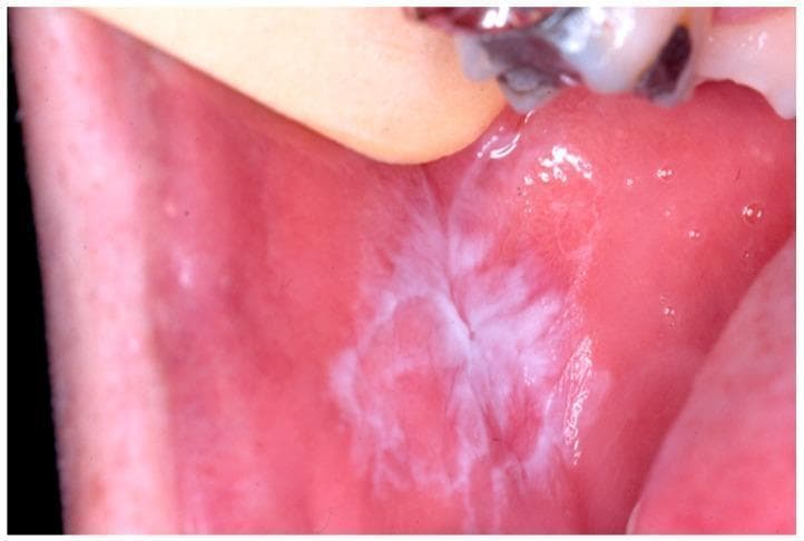 This clinical photograph displays a high-resolution intraoral view of the right buccal mucosa, demonstrating the classic presentation of Oral Lichen Planus (OLP), reticular type. The image highlights Wickham striae—a characteristic network of interlacing white, thread-like keratotic lines. These lesions appear as slightly elevated, white, reticular patterns distributed irregularly across an erythematous base. The surrounding mucosal tissue is primarily pink and smooth, though there is evidence of mild perilesional inflammation. This visual serves as a primary educational example for diagnosing mucocutaneous diseases in oral medicine and dentistry, emphasizing the morphological distinction between reticular and erosive forms of Lichen Planus. The absence of ulceration or overt atrophy reinforces the classification as a stable reticular manifestation of the condition.