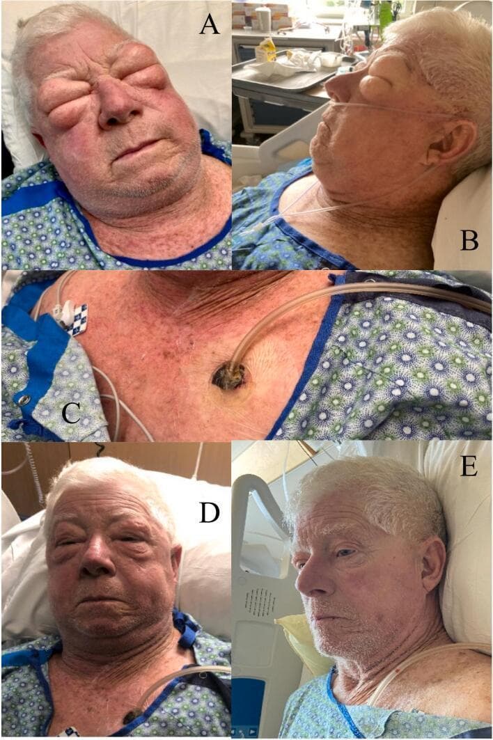 This clinical photographic series documents the presentation and treatment of severe Grade IV subcutaneous emphysema (SSE) in an adult patient. Images A and B show massive facial and cervical swelling on hospital day 5, with significant periorbital edema resulting in the eyes being swollen shut and loss of normal facial contours. Image C illustrates the procedural intervention: incisional negative pressure wound therapy (iNPWT) applied to the left anterior chest wall. A small incision is visible with a suction tube and occlusive dressing, designed to facilitate the evacuation of trapped subcutaneous air. Images D and E show a chronological timeline of clinical improvement. At 24 hours post-intervention (D), there is a noticeable reduction in facial puffiness, allowing the patient to partially open their eyes. By 48 hours (E), there is near-total resolution of the SSE, with facial features returning to baseline and the disappearance of the previously taut, distended skin. This series demonstrates the efficacy of iNPWT in managing rapidly progressive subcutaneous air accumulation.