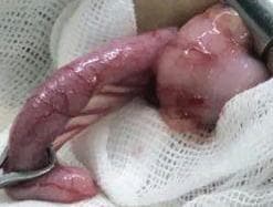 Clinical photograph of an acutely inflamed vermiform appendix immediately following surgical excision (appendectomy). The specimen is approximately 8 cm in length and demonstrates classic morphological features of acute appendicitis. The serosal surface is intensely erythematous and congested with a reddish-pink hue. Notable pathological findings include diffuse edema resulting in a swollen, non-uniform diameter, and the presence of fibrinopurulent exudate across the irregular, moist surface. The distal portion appears more bulbous and distended. Small focal petechial hemorrhages (blood spots) are visible along the organ's length. The specimen is positioned against sterile surgical gauze and held by surgical instruments, illustrating the macroscopic appearance of suppurative appendicitis and periappendicitis for educational purposes in general surgery and pathology.