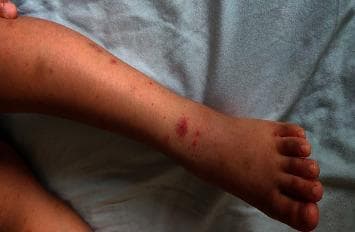 This clinical photograph displays a pediatric patient's lower extremity, showing a characteristic non-blanching purpuric rash. The lesions are distributed along the lower leg and dorsal aspect of the foot, exhibiting an ascending pattern. The morphology of the rash includes individual red-to-purple petechiae (pinpoint lesions) and larger, palpable purpura that have become confluent in areas above the ankle. The distribution appears scattered but predominantly involves the extensor surfaces. This visual finding is highly suggestive of immunoglobulin A (IgA) vasculitis, formerly known as Henoch-Schönlein purpura (HSP), particularly when associated with the clinical context of joint pain, abdominal symptoms, or hematochezia. The image serves as an educational example of cutaneous small-vessel vasculitis in a child, emphasizing the recognition of palpable purpura in dependent areas as a primary diagnostic sign.