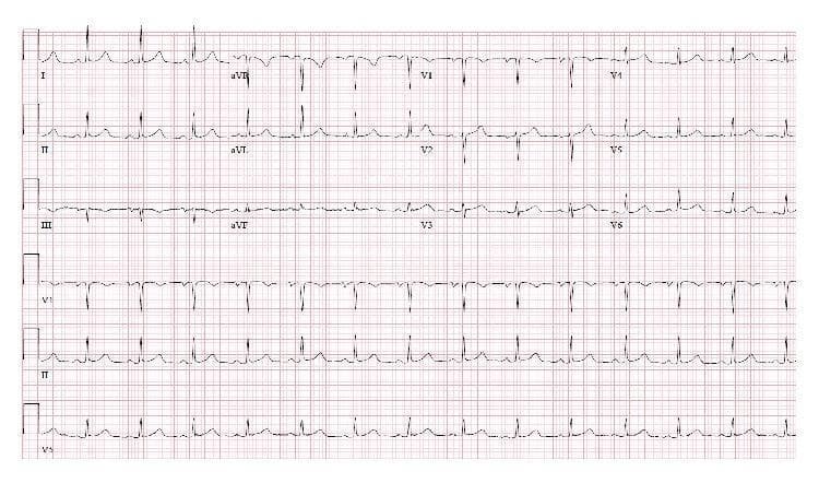 This diagnostic image is a standard 12-lead electrocardiogram (ECG) displayed on a red grid background. The tracing demonstrates a regular sinus rhythm at an approximate heart rate of 80–90 beats per minute. The rhythm exhibits normal P-wave morphology followed by a 1:1 atrioventricular conduction. The QRS complexes are narrow (duration < 120 ms) with normal axis and morphology across both limb (I, II, III, aVR, aVL, aVF) and precordial (V1–V6) leads. R-wave progression in the precordial leads appears normal. T waves are generally upright and concordant with the QRS complexes in most leads, with no evidence of acute ST-segment changes, pathological Q waves, or significant conduction delays. The tracing serves as a clinical illustration of resolved sinus bradycardia and restored normal sinus rhythm post-thyroidectomy for a massive multinodular goiter, demonstrating the absence of extrinsic mass effect on carotid sinus or autonomic structures.