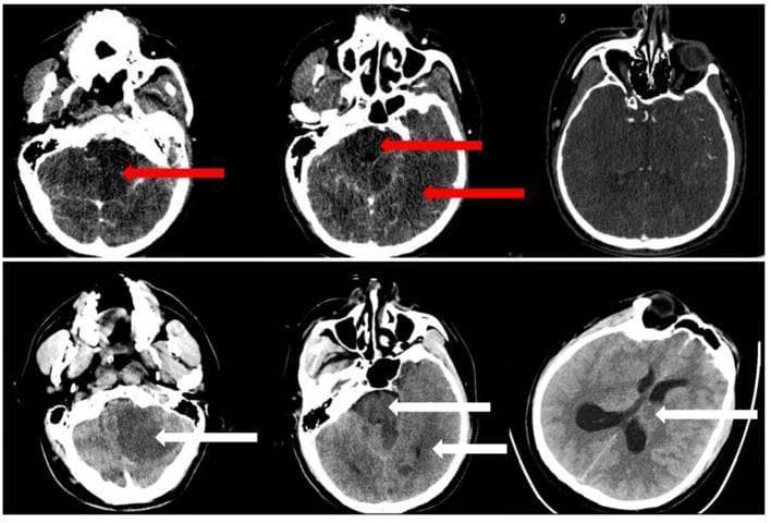 This diagnostic comparison displays axial brain CT images from a patient with basilar artery occlusion (BAO), illustrating the assessment of early ischemic changes using the posterior circulation Acute Stroke Prognosis Early CT Score (pc-ASPECTS). The upper row contains CT angiography source images (CTA-SI), where red arrows highlight focal hypoattenuation in the midbrain, left cerebellum, and left posterior cerebral artery (PCA) territory. The lower row shows follow-up non-contrast CT (NCCT) scans, where white arrows indicate progressive ischemic evolution, characterized by increased hypoattenuation in the previously noted regions and new involvement of the left thalamus. The visual findings demonstrate the transition from a pc-ASPECTS of 6 on initial CTA-SI to a lower score of 5 on NCCT, indicating expanding infarction. These images serve as an educational example of neuroradiological evaluation for posterior circulation strokes, emphasizing the identification of subtle density changes in the brainstem, cerebellum, and diencephalon to predict clinical outcomes.