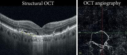 This diagnostic composite includes a structural Optical Coherence Tomography (OCT) cross-section and an OCT Angiography (OCTA) en face scan of the retina. The structural OCT demonstrates signs of choroidal neovascularization (CNV) complicated by retinal pigment epithelium (RPE) atrophy. Key pathological features include intraretinal cystic spaces indicative of edema and subretinal fluid situated above a sub-RPE hyperreflective material. A prominent area of RPE atrophy is marked by increased foveal backscattering of the OCT signal into the deeper choroid. The accompanying OCTA image displays a distinct, round flow signal with a peripheral capillary fringe, confirming active neovascularization. These images illustrate the clinical progression of CNV where secondary atrophy may limit visual outcomes despite anti-VEGF therapy. The content is suitable for ophthalmology students and specialists studying retinal pathologies and multimodal imaging interpretation.