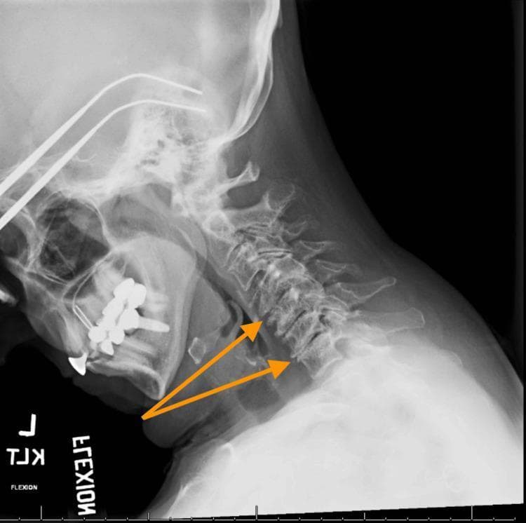 This lateral flexion X-ray of the cervical spine illustrates diagnostic signs of multilevel degenerative disc disease (cervical spondylosis). The radiograph captures the cervical vertebrae (C1-C7) in a forward flexed position to assess dynamic alignment and structural integrity. Key findings highlighted by orange arrows include significant intervertebral disc space narrowing at the C4-C5 and C6-C7 levels. While the overall spinal alignment is maintained without evidence of spondylolisthesis or dynamic instability in this view, the reduction in disc height suggests progressive discogenic degeneration. The image also displays the base of the skull, the mandible with dental hardware, and the posterior elements of the spine. This clinical imaging is essential for evaluating mechanical neck pain and neuroforaminal narrowing associated with chronic spinal wear.