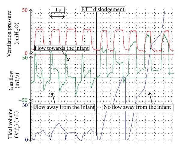 A respiratory function monitor (RFM) graphical display illustrating the effect of accidental endotracheal tube (ETT) dislodgement during neonatal positive pressure ventilation (PPV). The image presents three stacked physiological waveforms over time: Ventilation pressure (cmH2O), Gas flow (mL/s), and Tidal volume (VT in mL).
Initially, the waveforms show synchronous ventilation: rhythmic pressure cycles correlate with biphasic gas flow (inspiratory flow toward the infant and expiratory flow away) and consistent tidal volume peaks. A vertical line marks the 'ETT dislodgement' event. Post-dislodgement, while the ventilator continues to provide rhythmic pressure (PIP and PEEP), the gas flow waveform loses its negative deflection (no flow away from the infant), and the tidal volume waveform becomes erratic, losing its cyclical expiratory return to baseline. This illustrates a total leak where air is delivered by the ventilator but fails to reach the lungs or return through the flow sensor, serving as a critical diagnostic indicator for accidental extubation during neonatal intensive care or transport.