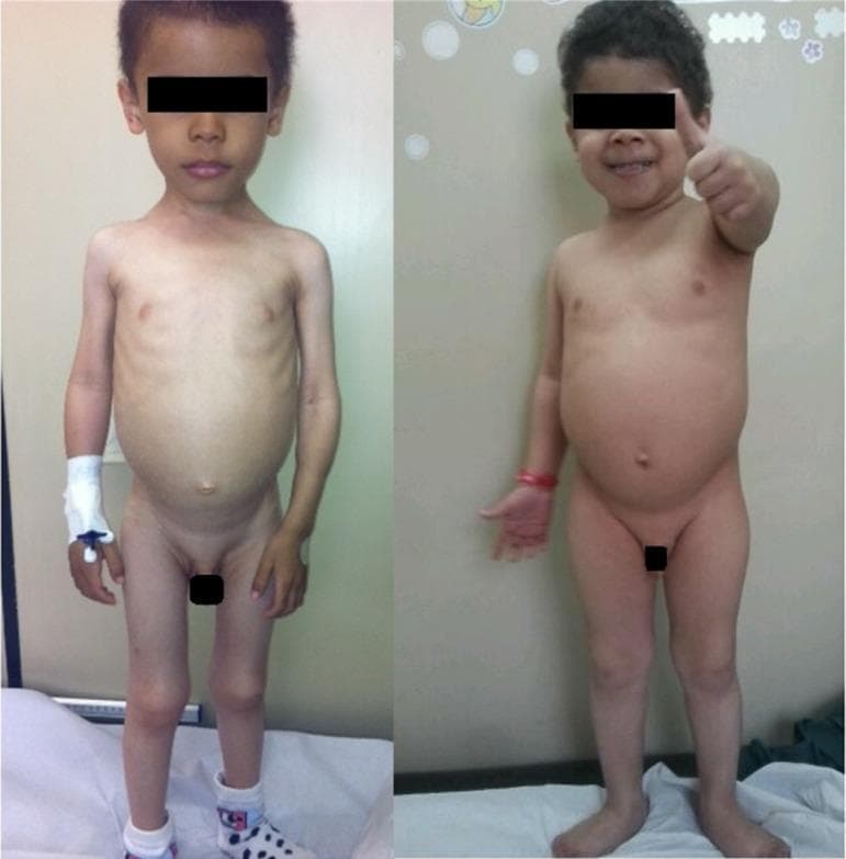 A clinical comparison photograph demonstrating the progression of nutritional recovery in a pediatric patient with severe protein-calorie malnutrition. The left image (initial consultation) shows a male child exhibiting signs of marasmus/kwashiorkor-like features: severe wasting of the limbs, prominent ribcage (skeletal prominence), and a distended, protuberant abdomen. The patient appears apathetic with an intravenous catheter in the right hand. The right image (two months post-intervention) shows the same patient after a high-calorie, high-protein dietary regimen. Visible clinical improvements include significant weight gain, replenishment of subcutaneous fat and muscle mass (limbs appear fuller, ribs no longer visible), and improved postural muscle tone. The patient's facial expression and a 'thumbs-up' gesture indicate improved mood and neurological status. This comparison illustrates the physical manifestations of successful nutritional rehabilitation in cases of severe malnutrition or neglect, serving as an educational example of catch-up growth and clinical recovery in pediatrics.