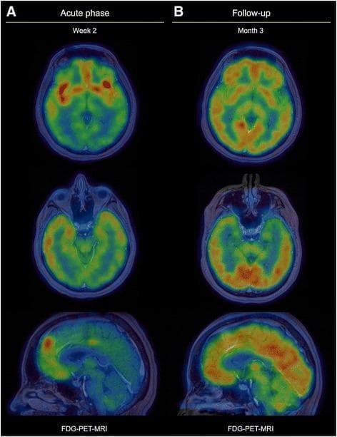 This diagnostic comparison chart features axial and sagittal F18-FDG-PET/MRI fusion scans illustrating the metabolic evolution of anti-NMDA receptor (NMDAR) encephalitis. The images are divided into two columns: the 'Acute phase' (Week 2) and the 'Follow-up' (Month 3). In the acute phase (A), the F18-FDG-PET shows significant glucose hypermetabolism (red/orange) in the bilateral insular and prefrontal cortices, accompanied by relative hypometabolism (cool blue/green) in the occipital and posterior parietal lobes. In the follow-up phase (B), after treatment and clinical improvement, the metabolic pattern has shifted dramatically. The previously hypermetabolic insular and hippocampal regions now exhibit marked glucose hypometabolism, while glucose uptake in the prefrontal, occipital, and parietal regions has normalized. These co-registered images demonstrate the characteristic metabolic fluctuations associated with autoimmune encephalitis, emphasizing the value of PET imaging in monitoring disease progression and response to immunotherapy beyond conventional MRI findings.