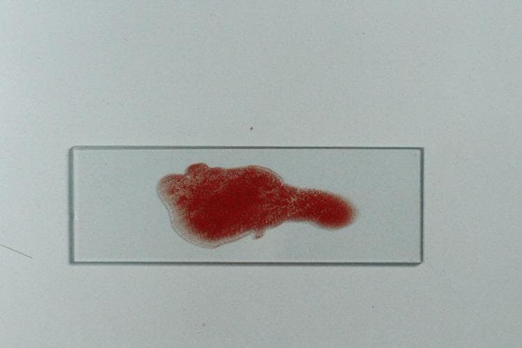 This clinical photograph displays a macro-level view of a laboratory specimen on a clear glass microscope slide, demonstrating a positive agglutination reaction. The sample consists of erythrocytes suspended in a liquid medium, which has formed distinct, granular clumps of red cellular material. This macro-clumping is a hallmark of a positive hemagglutination test, where antibodies in the antiserum have cross-linked with antigens on the red blood cell surfaces. The distribution of the red sample is non-uniform, showing a dense, opaque central cluster with irregular, diffuse margins and a lighter peripheral halo where cells are less concentrated. This procedure is commonly used in immunohematology for ABO blood group determination and secretor status analysis via the absorption-inhibition method. The presence of visible clumping in this context signifies a lack of neutralizing antigens in the tested saliva, indicative of a non-secretor phenotype or a positive control result.