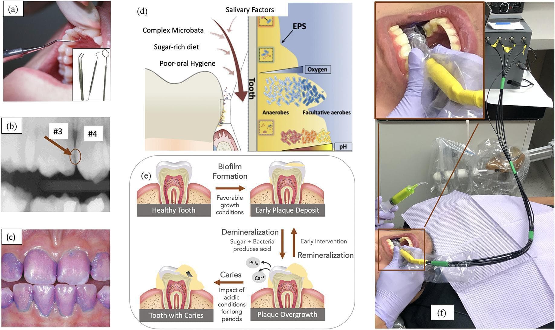 This composite educational graphic illustrates the diagnosis and pathophysiology of dental caries and biofilm. (a) Intraoral clinical photograph showing visual assessment of occlusal surfaces using a dental probe. (b) Bitewing radiograph demonstrating a radiolucent interproximal lesion between teeth #3 and #4. (c) Clinical photograph showing dental plaque visualized with a purple-pink disclosing agent, emphasizing accumulation at gingival margins. (d) Pathophysiology diagram of the biofilm micro-environment, highlighting the Extracellular Polymeric Substance (EPS) matrix, oxygen gradients, and the transition from facultative aerobes to anaerobes as pH decreases near the enamel. (e) Flowchart depicting the progression from a healthy tooth to early plaque deposit, demineralization (loss of Ca2+ and PO4 due to acid production), and finally carious cavitation. It notes the reversible nature of early lesions via remineralization and intervention. (f) Clinical demonstration of an O-pH optical sensor probe used to measure biofilm acidity in real-time. This material is designed for dental education, focusing on the interplay between oral hygiene, sugar-rich diets, and bacterial acidification in cariogenesis.