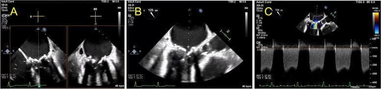 This composite of transesophageal echocardiography (TEE) images illustrates a degenerated bioprosthetic mitral valve presenting with severe stenosis. Panel A displays a biplane view at 0 and 90 degrees (mid-esophageal 4-chamber view), showing significantly thickened and calcified prosthetic leaflets with restricted diastolic motion and a reduced valve orifice. Panel B provides a long-axis view at 125 degrees during end-diastole, further confirming the structural degeneration and restricted opening of the bioprosthesis. Panel C features a continuous wave (CW) Doppler spectral tracing through the mitral valve in the long-axis view. The Doppler envelope is dense with a slow decay of the E-wave (prolonged pressure half-time), indicating severe obstruction. Quantitative assessment shows a peak velocity of approximately 2.5 m/s, consistent with a high transvalvular gradient. The image is a critical educational tool for identifying structural valve deterioration (SVD) in prosthetic mitral valves and utilizing spectral Doppler for hemodynamic quantification of mitral stenosis.