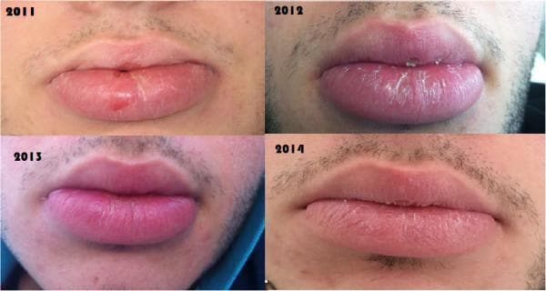 A series of four clinical photographs demonstrating the progression of cheilitis granulomatosa of the lower lip in a patient with Crohn's disease over a four-year period (2011–2014) during infliximab therapy. The 2011 image shows severe, macrocheilia-type swelling of the lower lip with an indistinct vermillion border, distorted shape, and a visible surface erosion or ulceration. The 2012 image reveals persistent but slightly reduced edema with significant xerosis and fine white desquamation. By 2013, there is a further decrease in lip volume and a progressive return of the natural anatomical contour. The final 2014 image shows significant clinical improvement with minimal residual swelling, a clearly defined vermillion border, and a relatively smooth surface texture. This longitudinal comparison illustrates the therapeutic response of orofacial granulomatosis to anti-TNF-alpha biological therapy, highlighting the resolution of granulomatous inflammation and secondary cutaneous manifestations like edema and surface erosions.