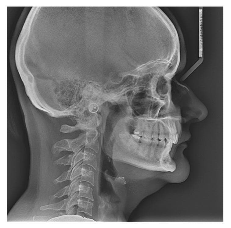 This diagnostic image is a lateral cephalogram (x-ray radiography) of the human skull and cervical spine. The imaging captures the sagittal profile, displaying the cranium (frontal, parietal, and occipital bones), facial bones, and the upper cervical vertebrae (C1-C5). Key anatomical landmarks visible include the sella turcica, nasal bone, maxilla, and mandible. The radiograph clearly demonstrates the relationship between the maxillary and mandibular dental arches, showing the occlusion of the anterior and posterior teeth. Soft tissue contours of the nose, lips, chin, and posterior airway space are also visible. In the upper right corner, a calibration ruler is present for linear measurements. This modality is primarily used in orthodontics and maxillofacial surgery to evaluate craniofacial growth, dentofacial proportions, and craniocervical posture, including the assessment of angles and distances such as the craniovertebral angle and hyoid bone position.