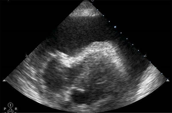 This diagnostic image is a transthoracic echocardiogram (ultrasound) in a subcostal or apical view, demonstrating a large pericardial effusion leading to cardiac tamponade. The most prominent feature is a significant, echo-free (anechoic to hypoechoic) space surrounding the cardiac structures, which represents fluid accumulation within the pericardial sac. Centrally, the heart appears relatively small or compressed within this large volume of fluid. The ultrasound shows the characteristic grayscale appearance of the myocardium and endocardium, though the cardiac chambers are obscured by the surrounding effusion. Clinically, this visual finding is pathognomonic for cardiac tamponade when associated with hemodynamic instability, as the intrapericardial pressure exceeds intracardiac filling pressure, compromising cardiac output. This image serves as a critical educational tool for emergency physicians and cardiologists in identifying life-threatening obstructive shock through point-of-care ultrasound (POCUS).
