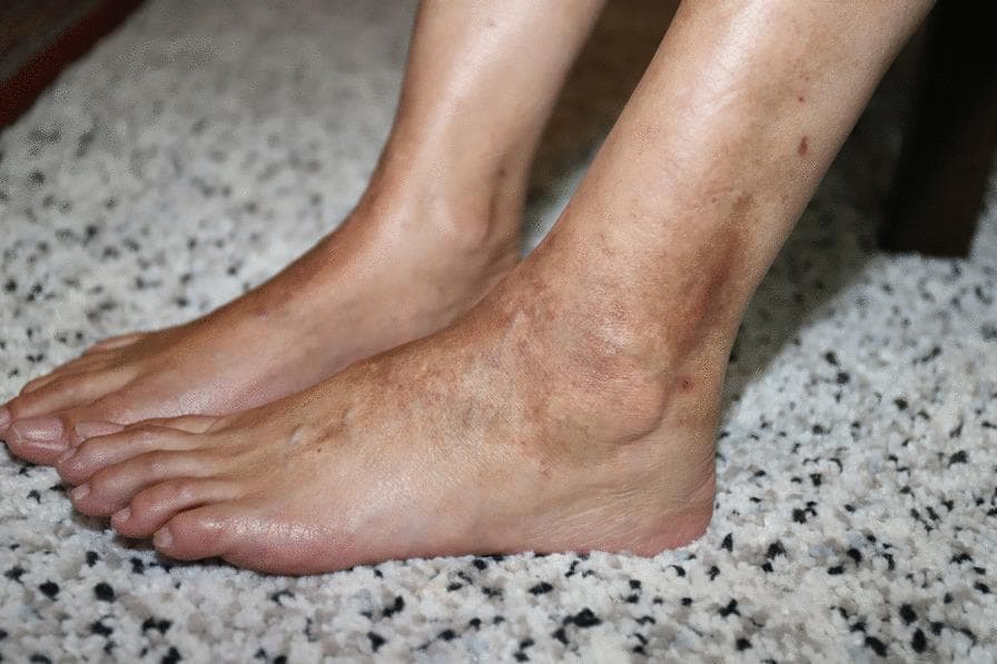 This clinical photograph displays the bilateral lower limbs and feet of a patient presenting with Pigmented Purpuric Dermatosis (PPD), likely Schamberg disease. The image shows a symmetrical distribution of non-blanching, reddish-brown to orange-brown macules and patches concentrated around the ankles and shins. Key visual features include a characteristic 'cayenne pepper' appearance caused by petechial hemorrhage within the lesions. The affected areas exhibit a combination of fresh purpura and chronic hyperpigmented patches resulting from hemosiderin deposition. The skin texture appears largely intact with fine wrinkling, without prominent edema, ulceration, or signs of major venous insufficiency. This image is educational for identifying the morphology of pigmented purpuric eruptions, which are clinically distinguished from vasculitis by their typical color and indolent appearance. Relevant medical concepts include red blood cell extravasation, capillary fragility, and medication-induced dermatoses.