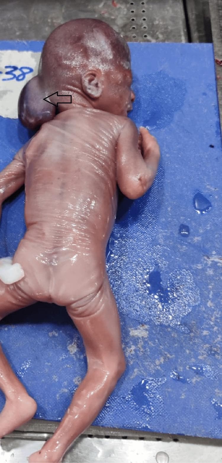 A clinical photograph of a fetus in posterior view, demonstrating a large occipital encephalocele. The primary pathology is a significant, sac-like protrusion in the occipital region of the head, indicated by a black arrow. This mass is smooth, taut, and spherical, representing the herniation of intracranial contents through a midline skull defect. The fetus exhibits thin, translucent skin with visible underlying vascular patterns, characteristic of early second-trimester development. The limbs appear well-formed but are positioned in a flexed posture. The image serves as a clear educational example of a cranial neural tube defect (NTD). It is highly relevant for medical studies in embryology, obstetrics, and pathology, specifically illustrating the morphological presentation of encephaloceles versus other cranial defects like anencephaly or exencephaly.
