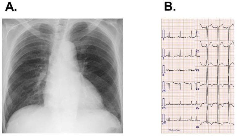 This composite medical image presents diagnostic findings for a patient with heart failure. Panel A is a posterior-anterior (PA) chest X-ray demonstrating mild cardiomegaly with a prominent cardiac silhouette and signs of bilateral pulmonary congestion, evidenced by increased bronchovascular markings in the hilar and basal regions. Panel B is a 12-lead electrocardiogram (ECG) showing normal sinus rhythm. The ECG is characterized by high-voltage QRS complexes in the precordial leads and deep T-wave inversions with a 'strain pattern' in leads V4 through V6. Together, these findings illustrate clinical signs of left ventricular hypertrophy and cardiac remodeling, consistent with a diagnosis of dilated cardiomyopathy. This material is designed for medical education regarding the correlation between radiological imaging and electrophysiological data in chronic heart failure management.