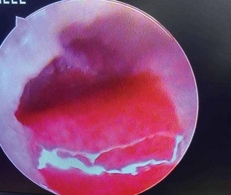 This clinical photograph is an endoscopic view of the external auditory canal (EAC), illustrating a granulation polyp. The primary feature is a large, erythematous, and fleshy mass that partially or completely occupies the canal lumen. The mass displays a heterogeneous red-to-purple hue, suggesting significant vascularity and inflammation. Its surface texture is irregular and granular, characteristic of granulation tissue. Near the inferior aspect of the lesion, light-colored, winding bands are visible, representing serous or purulent fluid-filled tracks or mucopurulent discharge commonly associated with chronic suppurative otitis media (CSOM). This visual provides a clinical example of an aural polyp, which is a significant finding in otolaryngology as it may obscure the view of the tympanic membrane and can be associated with underlying conditions such as cholesteatoma or malignant otitis externa. The image is intended for medical students and clinicians to recognize inflammatory middle ear disease complications.