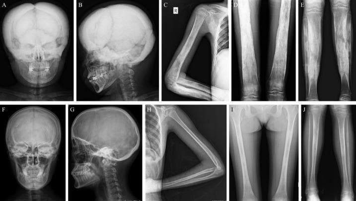 A composite image of 10 X-ray radiographs illustrating varying phenotypic expressions of Camurati-Engelmann Disease (CED), also known as progressive diaphyseal dysplasia. The image compares severe (A-E) and mild (F-J) radiological manifestations in adolescent and adult female patients.
Panels A and B (severe) demonstrate significant hyperostosis and sclerosis of the skull and skull base, appearing radiopaque and thickened compared to the relatively normal skull morphology in F and G (mild). Panels C-E (severe) show marked cortical thickening of the diaphyses in long bones—including the humerus, radius, ulna, femur, and tibia—resulting in significant narrowing of the medullary canals. In contrast, panels H-J (mild) show only slight or focal cortical thickening, particularly in the ulna and tibia, with more preserved medullary spaces. The series serves as an educational reference for identifying characteristic symmetric, skeletal changes associated with CED, emphasizing the progression of bone density and marrow space obliteration in long bone shafts.
