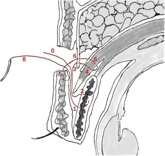 This medical anatomical diagram illustrates a sagittal cross-section of the upper eyelid, detailing the 'flexible-rigid fixation' technique used in small-incision blepharoplasty (double eyelid surgery). The illustration shows the surgical pathway of a mattress suture, color-coded in red and numbered 0 through 8 to indicate the sequence of needle passage. The suture begins at the incision site (0), engages the anterior tarsus fascia or tarsal plate (1-2), and then traverses superiorly through the levator aponeurosis and the retro-orbital septum complex (3-6). The needle is then reversed to anchor the suture to the lower lip of the orbicularis oculi muscle (7) before exiting (8). Key anatomical structures depicted include the skin, pretarsal and preseptal orbicularis oculi muscles, tarsal plate, levator aponeurosis, orbital septum, and preaponeurotic fat pads. This educational diagram demonstrates how the technique establishes an indirect link between the levator mechanism and the skin to create a natural-looking eyelid crease through both stable (rigid) and dynamic (flexible) tissue approximation.