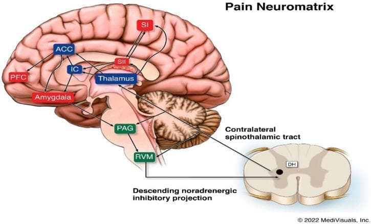 This pathophysiology diagram illustrates the 'Pain Neuromatrix,' detailing the complex network of cortical and subcortical structures involved in pain perception. The schematic features a sagittal view of the human brain and a cross-section of the spinal cord. An ascending pathway is shown via the contralateral spinothalamic tract, originating from the dorsal horn (DH) of the spinal cord and projecting to the Thalamus. Subcortical nodes including the Periaqueductal Gray (PAG) and Rostral Ventral Medulla (RVM) are depicted in the brainstem, with a labeled descending noradrenergic inhibitory projection returning to the DH. Cortical regions highlighted include the Primary Somatosensory Cortex (SI), Secondary Somatosensory Cortex (SII), Anterior Cingulate Cortex (ACC), Prefrontal Cortex (PFC), and Insular Cortex (IC), alongside the Amygdala. Interconnecting arrows demonstrate the bidirectional flow between the Thalamus, limbic structures, and sensory-cognitive cortical areas, emphasizing that pain is a distributed neural process rather than a linear pathway. This resource is suitable for medical education on neuroanatomy and chronic pain mechanisms.