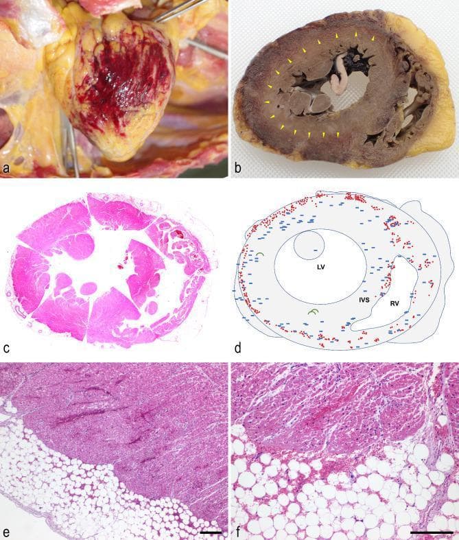 A multi-panel figure illustrating macroscopic and microscopic findings of the heart during autopsy. Figure 1a is a clinical photograph showing the posterior pericardium in situ with marked petechial hemorrhages. Figure 1b displays a cross-sectional gross specimen of the heart after fixation; yellow arrowheads indicate a circumferential black-red discoloration involving the pericardium and the superficial myocardium. Figure 1c provides a whole-mount scanning magnification of a transverse heart section stained with hematoxylin and eosin (H&E). Figure 1d is a schematic diagram mapping the pathology: red dots represent microscopic hemorrhage, blue rectangles indicate microthrombi, and green arcs signify areas of contraction band necrosis. Figures 1e and 1f provide low- and high-power H&E micrographs, respectively, demonstrating extensive hemorrhage within the epicardial fat and the adjacent cardiomyocytes of the myocardium. The pathology is characterized by multifocal microthrombi in small vessels and capillaries at the border of hemorrhagic regions, alongside contraction band necrosis, relevant to cardiovascular pathology and forensic medicine.