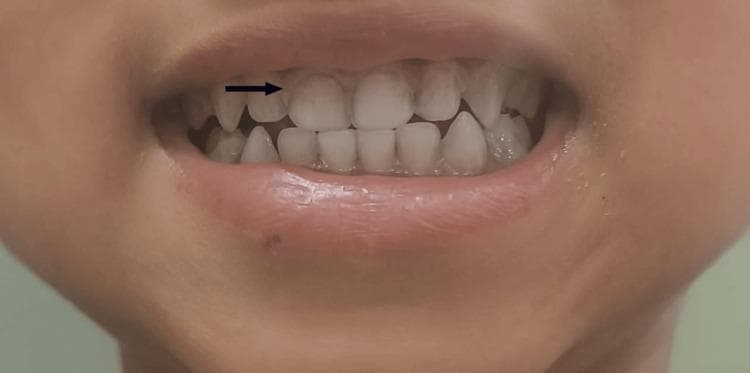 This clinical intraoral photograph displays the maxillary and mandibular anterior teeth and gingiva of a patient. The primary finding is a thin, bluish-purple hyperpigmented line appearing along the gingival margin of the upper teeth, classically known as Burton's line. A horizontal black arrow highlights this discoloration where the gingiva meets the dental enamel. The gums otherwise appear pale pink, and the lips show signs of mild pallor. This finding is a characteristic clinical sign of chronic lead poisoning (plumbism), resulting from the reaction of circulating lead with sulfur-producing bacteria in the oral cavity, which precipitates lead sulfide at the gum line. The image serves as a diagnostic reference for identifying heavy metal toxicity during a physical examination.