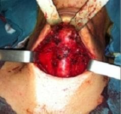 This clinical intraoperative photograph shows the anterior neck region during a surgical procedure, specifically following a total thyroidectomy. The operative field is exposed through a transverse cervical incision. Metallic surgical retractors are positioned laterally to maintain the retraction of the skin flaps and subcutaneous tissues, providing a clear view of the central neck compartment. The thyroid bed is visible, characterized by a raw, erythematous tissue surface with evidence of recent surgical dissection. No residual thyroid gland tissue is macroscopicially visible. The area shows expected post-surgical changes including minor fluid and heme presence on the exposed muscular and connective tissues. This image serves as a clinical example of the surgical site after the removal of the thyroid gland, typically performed for conditions such as thyroid carcinoma or thyroglossal duct cyst complications.