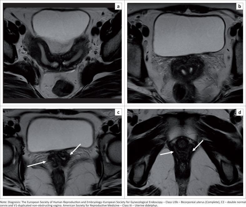This set of axial T2-weighted MRI scans displays a case of Uterine Didelphys (ESHRE/ESGE Class U3b, C2, V1), a Müllerian duct anomaly. Images (a) and (b) show the uterine fundus and lower uterine segment, respectively. These views demonstrate a deep fundal external indentation that exceeds 50% of the uterine wall thickness, resulting in the complete division of the uterine corpus into two separate horns. Images (c) and (d) focus on the lower reproductive tract. Image (c) shows two distinct cervical openings, and image (d) highlights the presence of two separate vaginal cavities, indicated by white arrows. The diagnostic significance of these findings lies in the complete duplication of the uterus, cervix, and vagina, characteristic of a fusion defect during embryological development. These features are essential for accurate classification and management of female reproductive tract anomalies.