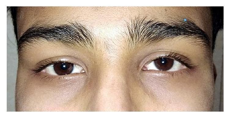A clinical photograph focusing on the periorbital region and eyes of a patient, demonstrating clinical improvement after 4 weeks of oral steroid therapy (1 mg/kg) for idiopathic acquired superior oblique (SO) palsy. The image shows the eyes in primary gaze with relatively symmetrical alignment. The irises are dark brown, and the sclera appears clear and non-icteric. There is a slight residual hyperdeviation of the left eye compared to the right, consistent with resolving hypertropia. The eyelids and surrounding skin are free of inflammatory signs, redness, or swelling. A small blue marking is visible on the patient's right eyebrow, likely a clinical marker for follow-up or examination. The visual illustrates the therapeutic response in a case of steroid-responsive cranial nerve palsy, where clinical features such as diplopia and ocular misalignment are being monitored during treatment tapering.