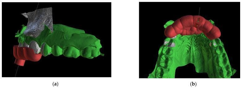 This diagnostic composite image displays a 3D digital planning model for guided endodontics, created by merging Cone Beam Computed Tomography (CBCT) DICOM data with intraoral scan STL files. The visualization depicts a maxillary dental arch in green, highlighting the anatomical crowns and gingival architecture. Superimposed in red is a custom, teeth-supported endodontic guide or template. View (a) shows the labial aspect, illustrating the guide's extension over the anterior teeth and a built-in cylindrical sleeve designed to dictate the path of a high-speed drill or endodontic file toward a calcified root canal. A metallic, textured 3D reconstruction of the bone or radiographic marker is visible superior to the teeth. View (b) presents the palatal/occlusal aspect, demonstrating the horseshoe-shaped template's stable seating across multiple teeth and its relationship to the palatal vault. A thin line indicates the planned virtual trajectory for precise access, intended to minimize tooth structure loss and prevent perforation during the localization of obliterated root canals.