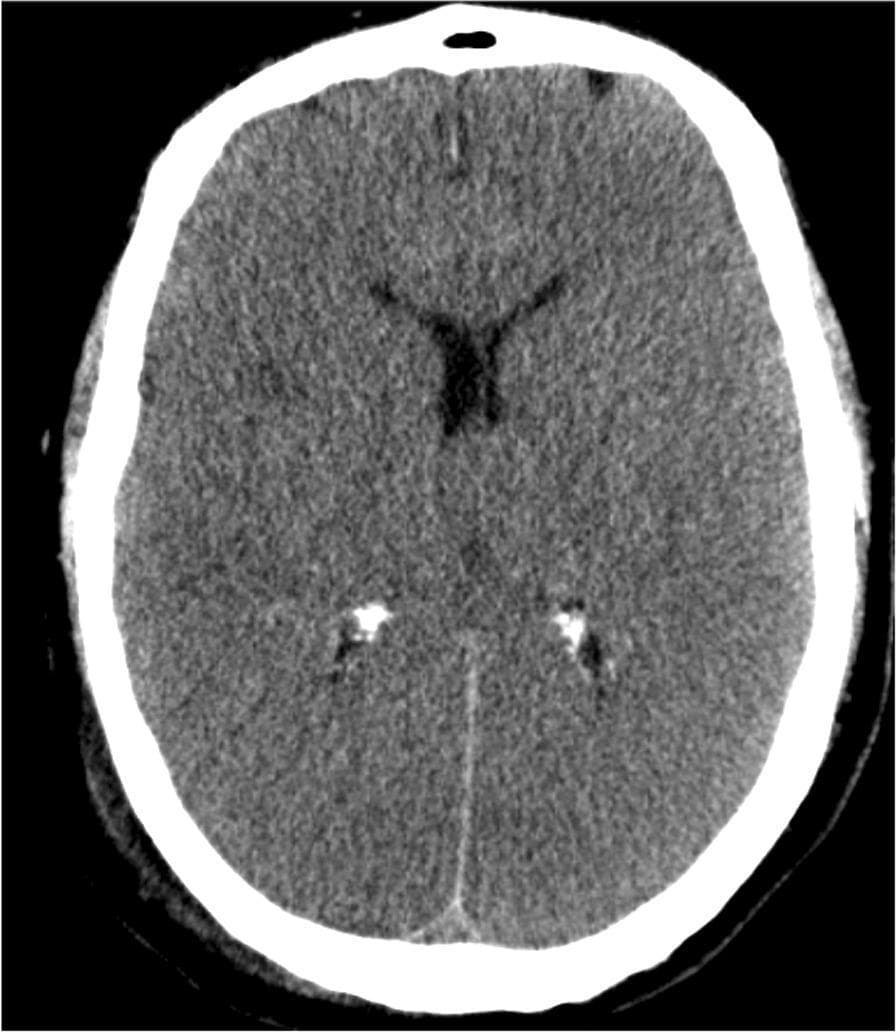 This diagnostic axial non-contrast computed tomography (CT) scan of the brain demonstrates significant signs of global cerebral edema. Key findings include diffuse cortical hypodensity across both cerebral hemispheres and a marked loss of grey-white matter differentiation, a hallmark of severe hypoxic-ischemic injury. The image shows prominent gyral effacement (flattening of the brain's convolutions) and the obliteration of the subarachnoid spaces and basal cisterns, indicating increased intracranial pressure. The ventricular system, particularly the lateral ventricles, appears slit-like and compressed. Hyperdense calcifications are visible in the choroid plexus of the posterior horns of the lateral ventricles, which is a common physiological finding. This CT appearance is clinically significant for neuroprognostication in cases of post-cardiac arrest or global anoxia, where the 'pseudo-delta sign' or generalized brain swelling reflects poor clinical outcomes.