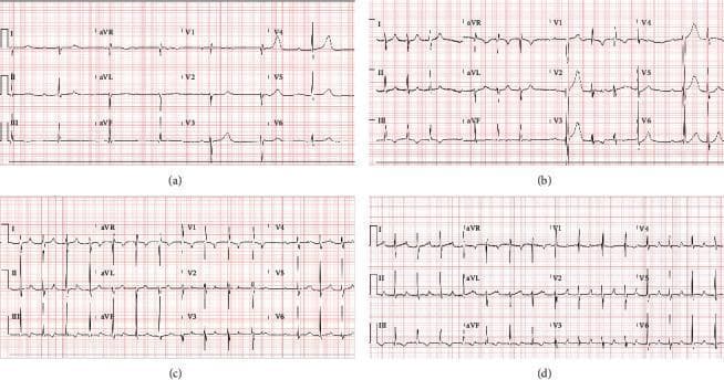A comparison of four 12-lead electrocardiogram (ECG) tracings illustrating the progression and types of atrioventricular (AV) conduction blocks. (a) Complete heart block (third-degree AV block) demonstrating atrioventricular dissociation with a slow, regular ventricular escape rhythm of 41 bpm and independent atrial activity. (b) Second-degree type 2 AV block (Mobitz II) showing intermittent non-conducted P waves with a constant PR interval in conducted beats. (c) Second-degree Mobitz type 1 AV block (Wenckebach) characterized by progressive lengthening of the PR interval until a QRS complex is dropped. (d) First-degree AV block displaying a 1:1 P-to-QRS ratio with a fixed, prolonged PR interval exceeding 200 ms (specifically >250 ms). The clinical series documents the evolution of conduction system abnormalities in a patient with myocarditis, showing transitions between high-grade blocks and milder conduction delays during treatment with isoproterenol and anti-inflammatory therapies.
