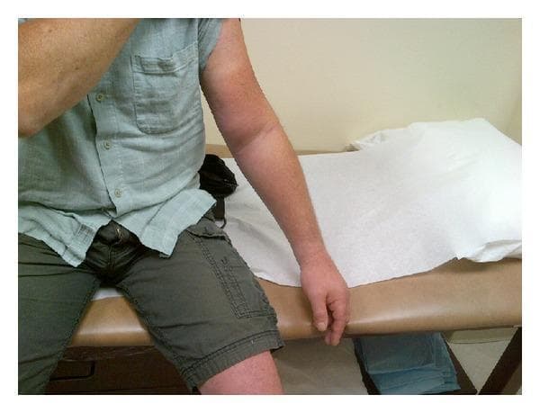 A clinical photograph depicting a patient seated on an examination table, illustrating a classic presentation of Upper Extremity Deep Vein Thrombosis (UEDVT). The focal point is the patient's left arm, which exhibits significant diffuse edema extending from the mid-humerus down through the forearm and hand. Distinct erythema (redness) and skin tautness are visible throughout the affected limb compared to the contralateral side. The swelling is particularly prominent in the antecubital and forearm regions, consistent with venous congestion. This image serves as an educational tool for identifying clinical signs of venous obstruction in a post-surgical or outpatient setting. The differential diagnosis for such presentation includes cellulitis, lymphedema, and superficial phlebitis, though the acute global swelling of the extremity strongly suggests DVT. The photograph is taken in a clinical environment, emphasizing the visual assessment necessary for early diagnosis of vascular complications.
