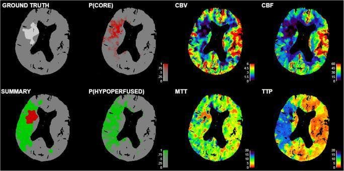 This diagnostic image set displays a series of axial CT perfusion maps and predictive models for an acute ischemic stroke. The panels are organized into ground truth, probability models, and raw perfusion parameters. The 'Ground Truth' and 'Summary' maps highlight the core infarct (red) and the surrounding hypoperfused penumbra (green) in the left hemisphere. Two probability maps, P(CORE) and P(HYPOPERFUSED), use red and green gradients respectively to illustrate the likelihood of tissue infarction based on recanalization status. The four perfusion maps demonstrate classic ischemic signatures: Cerebral Blood Flow (CBF) and Cerebral Blood Volume (CBV) show significant reductions (cool colors/darker blues) in the affected territory, while Mean Transit Time (MTT) and Time to Peak (TTP) show corresponding prolongations (warm colors/yellow-red), indicating delayed contrast arrival and transit. These maps are used in neurology and radiology to assess tissue viability and differentiate salvageable penumbra from the irreversible ischemic core, guiding treatment decisions such as thrombectomy or thrombolysis.