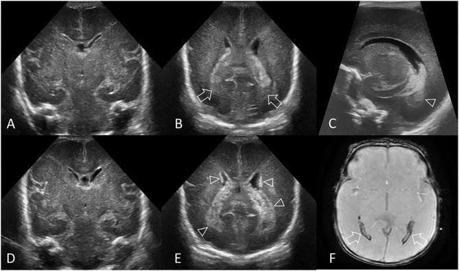 A multi-panel medical image illustrating the radiological evolution and retrospective diagnosis of intraventricular hemorrhage (IVH) in a preterm infant (GA 24 weeks). Panels (A) and (D) are coronal cranial ultrasound (cUS) scans at the level of the frontal horns showing initially normal lateral ventricles with no germinal matrix hemorrhage (GMH). Panel (B), a coronal scan at the level of the trigone, demonstrates small echogenic clots (arrows) within the posterior lateral ventricles. Panel (C) provides a parasagittal view confirming this small-volume IVH (arrowhead). Panel (E), a follow-up coronal scan 14 days later, reveals pathognomonic hyperechogenic ependyma (arrowheads) outlining the lateral ventricles, serving as an indirect sign of subacute IVH. Panel (F) is an axial T2* gradient-echo MRI scan taken 3 months post-birth, showing prominent hypointense susceptibility effects (arrows) in the occipital horns, indicating hemosiderin deposition from the previous hemorrhage. This series highlights the utility of serial ultrasound for identifying subacute changes like echogenic ependyma and MRI for confirming retrospective neonatal intracranial injury.