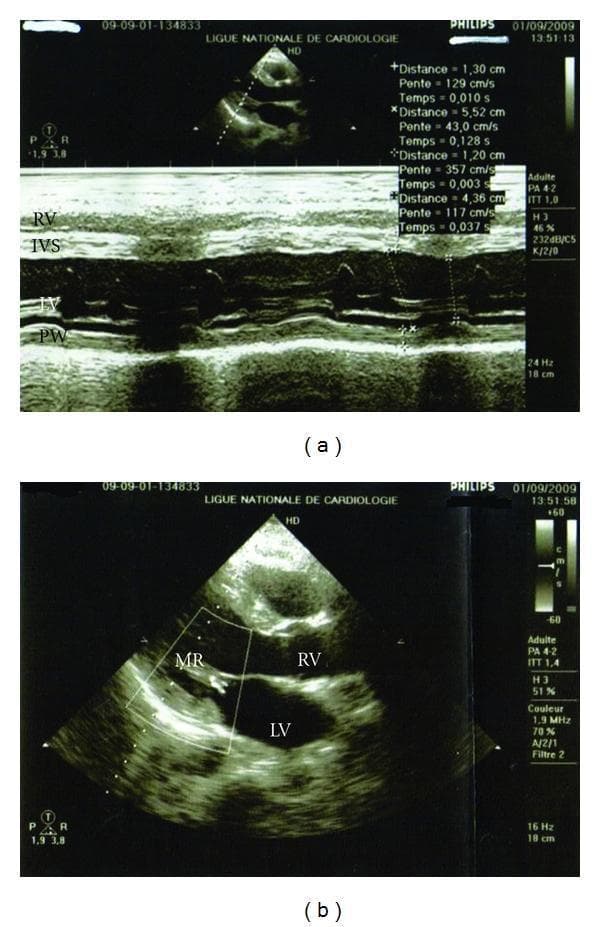 This clinical diagnostic image displays two panels of transthoracic echocardiography from a patient following Black Widow Spider (BWS) envenomation, illustrating myocarditis-like cardiac dysfunction and recovery.
Panel (a) features a M-mode echocardiogram in the parasternal long-axis view. It identifies the Right Ventricle (RV), Interventricular Septum (IVS), Left Ventricle (LV), and Posterior Wall (PW). The M-mode tracing is used to assess ventricular wall motion and dimensions, with quantitative measurements of distance and slope (velocity) visible on the right. This panel corresponds to an initial Left Ventricular Ejection Fraction (LVEF) of 48% with noted hypokinesis.
Panel (b) shows a 2D echocardiogram with color Doppler overlay in a similar view. Key cardiac chambers are labeled (RV, LV), and a color Doppler flow signal is identified as MR (Mitral Regurgitation) near the mitral valve. This follow-up image demonstrates clinical improvement, showing a reduction in mitral regurgitation to grade I and a recovering LVEF of 50%. The color scale on the right provides a reference for blood flow velocity and direction.